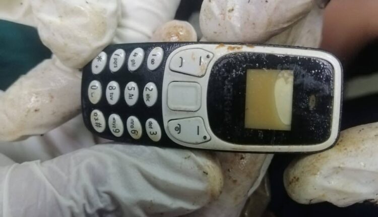 استخراج هاتف محمول من معدة مريض